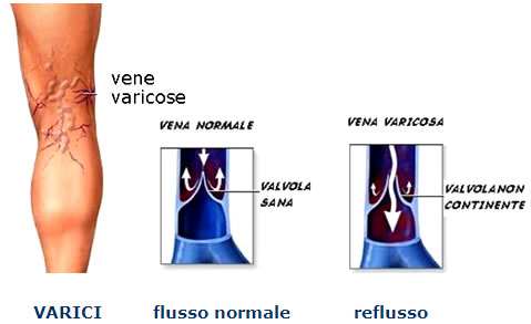 Trattamento di vene varicose da olio